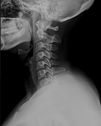 Рентген снимки остеохондроза